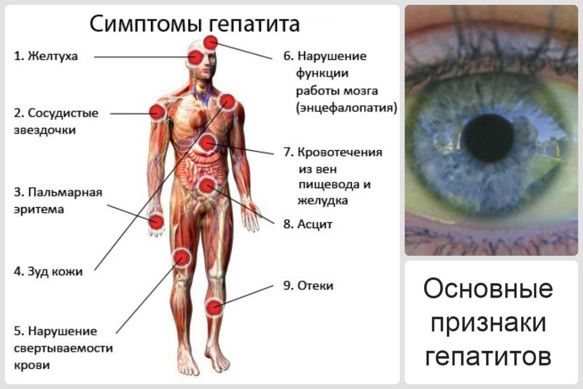 Сложности в выявлении вируса гепатита С- фото № 2 Сложности в выявлении вируса гепатита С